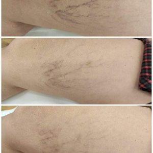 LASER ΚΑΤΑ ΤΩΝ ΚΙΡΣΩΝ