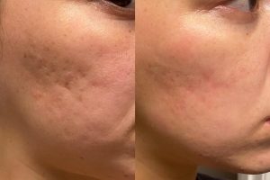 Microneedling